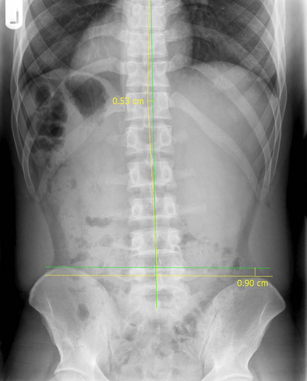 precision chiropractic Spine Lumbar xray after